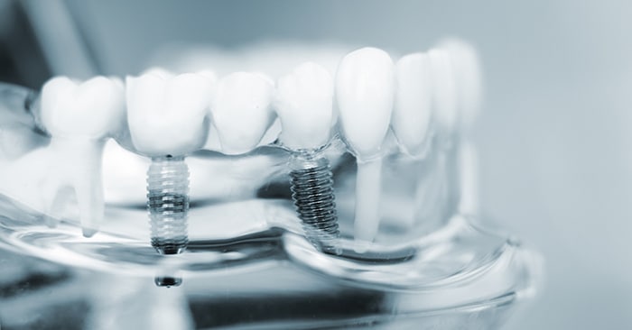 All-on-4 Dental Implant Innovation | Reclaim Your Smile